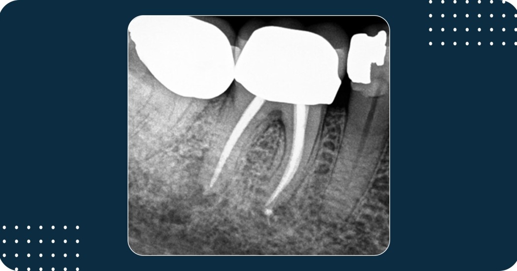 Discover how BioRoot® Flow revolutionizes root canal re-treatment in this compelling case study by Dr. Lauren Kuhn Nuth. Witness firsthand the transformative power of this mineral-based sealer with bioactive properties as it achieves excellent sealing and antimicrobial effects. Explore the innovative methods and technologies behind the success of this groundbreaking treatment approach.