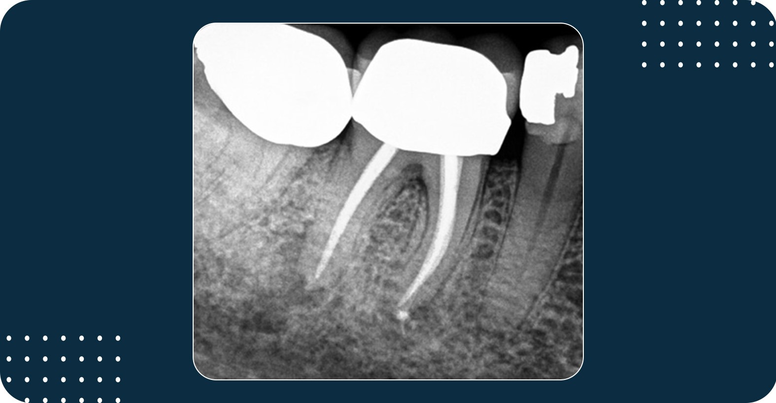 Root Canal Re-Treatment Success with BioRoot Flow - Septodont EN CA